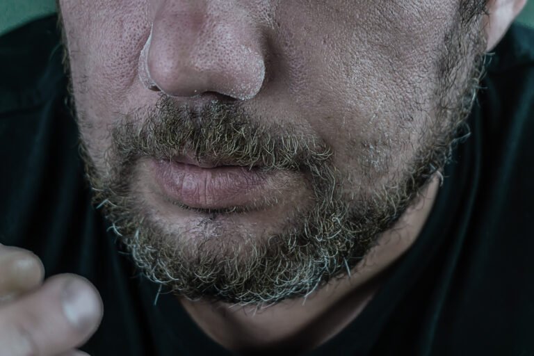 Patchy Beard Problem | Causes & Solutions Of Patchy Beard