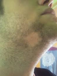 Beard Loss: Causes & Solution